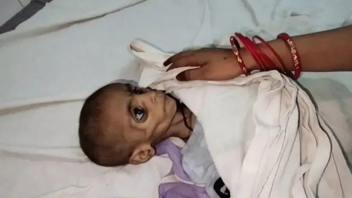 15 महीने की बच्ची, वजन सिर्फ 3.7KG… माँ के सामने कुपोषण से हुई मासूम की मौत, ससुराल वाले कहते रहे- मरने दे, लड़की ही तो है